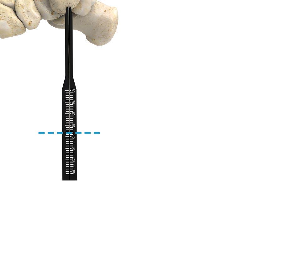 För in den 1,3 mm ogängade ledaren så att den är vinkelrät mot frakturlinjen och upptar den framtida positionen för lockskruven (se figur 68).