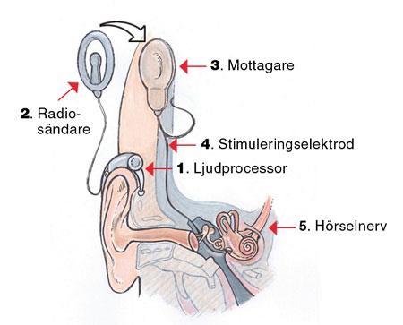 Cochleaimplantat (CI) CI är en hörapparat som har en yttre del som sitter bakom örat och en inre del, en platta som opereras in bakom örat, på temporalbenet under huden.