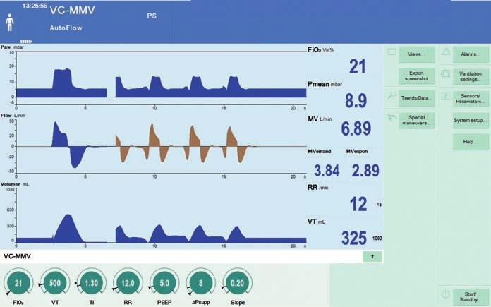 10 VC-MMV + AUTOFLOW AutoFlow (AF) säkerställer att inställd tidalvolym (VT) tillämpas med minsta nödvändiga tryck för alla volymkontrollerade, obligatoriska andetag.