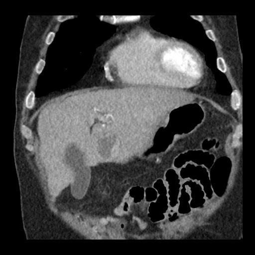 embolisering CBCT