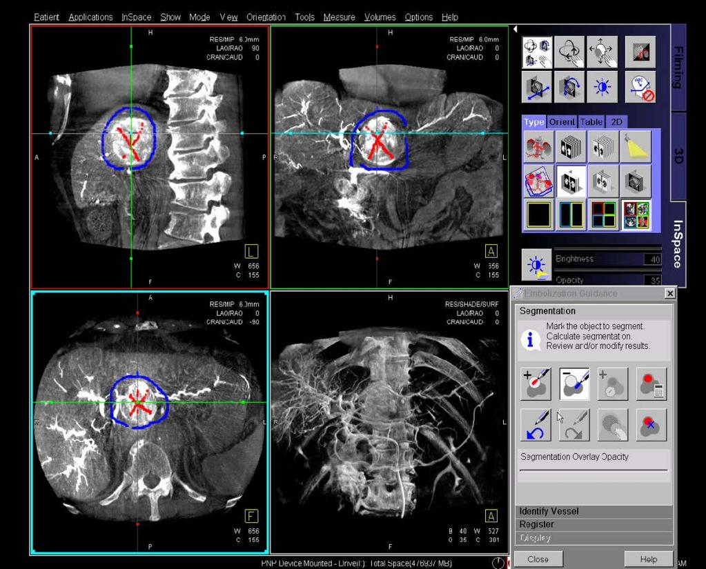 Emboliseringsguide, exempel: Courtesy of