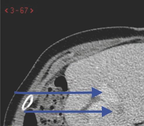 Metastas (nedre pilen) invid en gren från vena porta (övre pilen) hos en patient med kolorektal cancer med levermetastas som tidigare genomgått höger