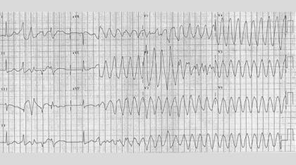 Hypercalcemi Magnesium, Mg 2+ Sällan ett intensivvårdsproblem Orsaken ofta HPT eller malignitet Neuropsykiatriska symptom, njurstenar Akut svår hyperkalcemi behandlas primärt med vätska och