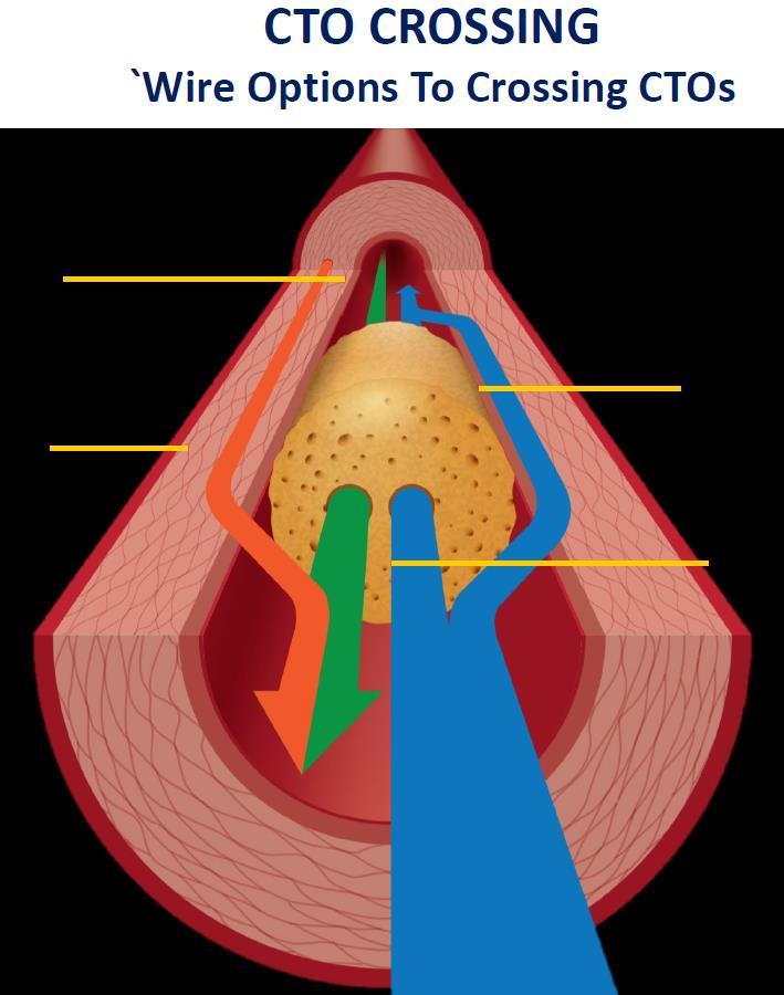 CTO-PCI teknik Antegrade wire escalation (AWE) Antegrade Dissection Re-entry