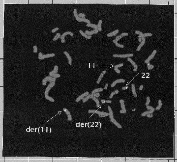 omfattande kromosomerna X och 1, t(x;1)(p11;q21), är ovanlig men uppenbarligen patognomon för papillära adenokarcinom. B.