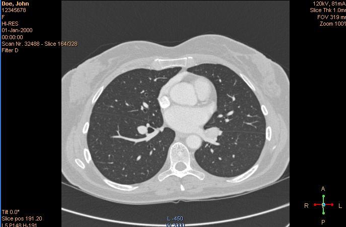 Computed Tomography -4/5- FSN88100003 23 maj 2012 ÅTGÄRDER SOM BÖR VIDTAS AV KUNDEN/ANVÄNDAREN När du som användare väljer flera patienter från PACS-arkivet i ett portalprogram