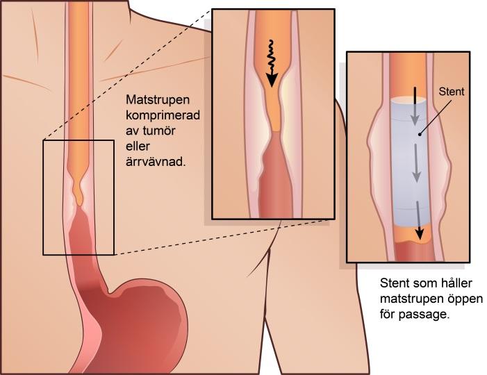 Vid kvarvarande sväljsvårigheter Ibland behöver passagen i matstrupen vidgas med ett så kallat stent som gör att du lättare kan svälja maten.