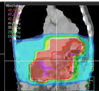 Nedan visas ett SIM-bildsförslag vid 2D-planerad postoperativ strålbehandling av en T3 N+ antrumtumör (Fig. 4). Fig. 4. Från: Smalley, S. R. et al. Int J Radiat Oncol Biol Phys.