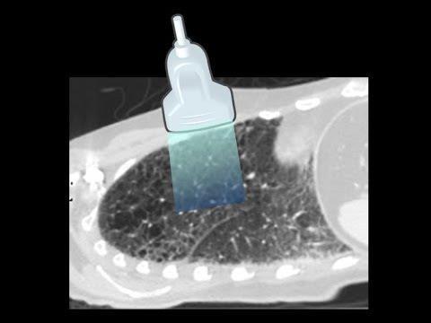 Ultraljud Ultraljud kommer utvecklas ytterligare och helt ersätta konventionell lungröntgen Automatisk