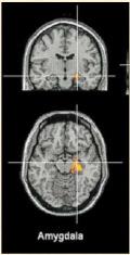 SEROTONIN OCH ÅNGEST SSRI dämpar reaktiviteten i amygdala vid negativ emotionell stimulering även hos friska frivilliga försöksdeltagare