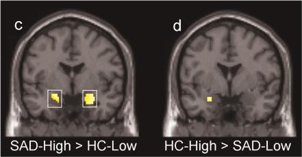 , Biol Psychiatry, 2006 Kontroller med högriskalleler (s,t) > Soc fobi med lågriskalleler (ll,gg) Furmark et al.