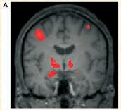, J Neurosci, 2007: Amygdala reaktiviteten (till ansikten) samvarierar med tillgängligheten av serotonintransportörproteinet