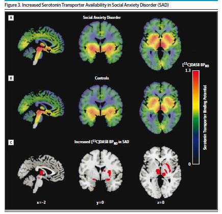 , JAMA Psychiatry, 2015 SEROTONINSYNTES VID SOCIAL FOBI SEROTONINSYNTES PET-studie: 11 C-5-HTP Social fobi (n=18) vs friska kontroller (n=16) Förhöjd ackumulation 11C- 5HTP dvs högre