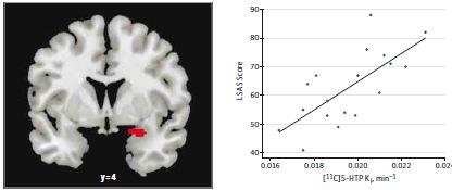 , JAMA Psychiatry, 2015 Synteshastigheten i amygdala korrelerade signifikant med symptomsvårighet ju högre serotoninsyntes desto högre ångest REPLIKATIONSSTUDIE PET-studie: 11 C-5-HTP