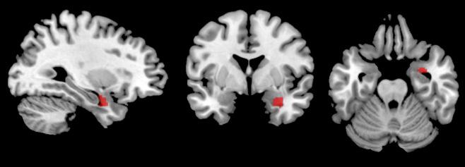 behandling, dubbel-blind RCT: SSRI (citalopram, 40mg) vs.