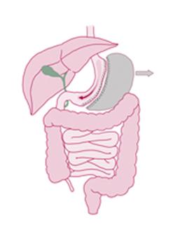 Gastric bypass Sleeve gastrektomi Ett utskrivet dokuments giltighet