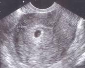 5+ veckor Gulesäck= intrauterint Bör ses när hinnsäck >8mm Hinnsäcken växer