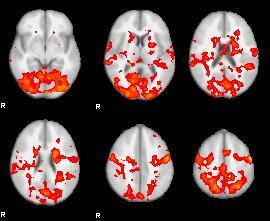 Post-TBI Impaired Activation: Functional MRI Condition 1 vs 3 Controls TBI During a spatial