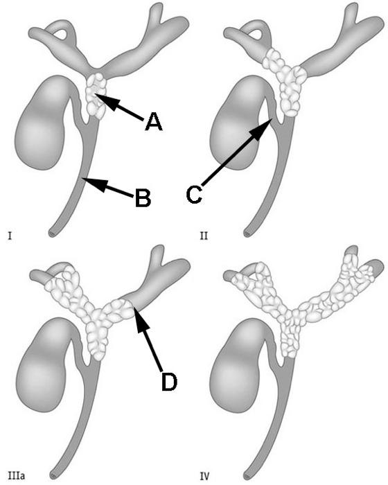 Svar: A: ductus hepaticus communis; B: ductus choledochus; C: ductus cysticus; D: ductus hepaticus sinister.