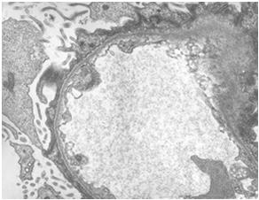 av podocyternas fotutskott Vanligaste orsaken till nefrotiskt syndrom hos barn - 90 % svarar på steroider, biopsi om recidiv (70%) eller