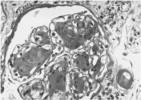 Diabetesnefropati Tidig fas Hyperfiltration (0-5 år) Hypertrofi, basalmembransförtjockning Incipient nefropati ( 5-10 år) Mikroalbuminuri 20-200 µg/min (30-300mg/d) Sen fas ( > 10 år) Manifest