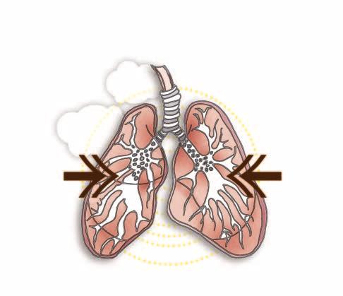 Kvarts kan orsaka stendammslunga, silikos. Exponering för kvarts kan även öka risken för lungcancer.