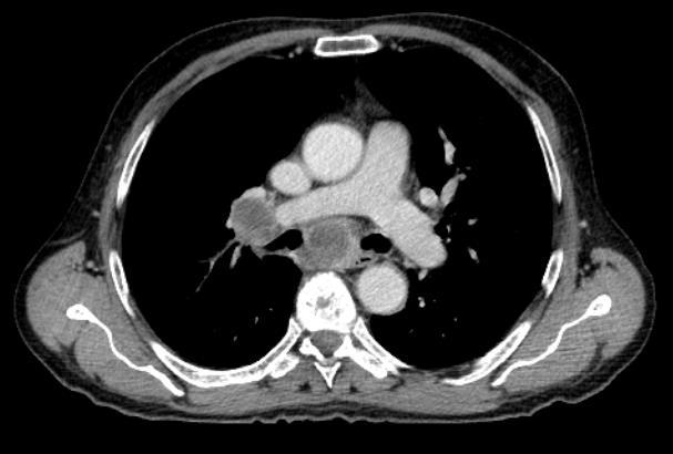 PET-CT Positronemissionstomografi (PET)