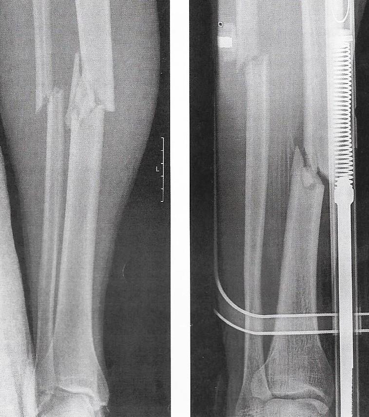 Underbensfraktur Utan och traktion
