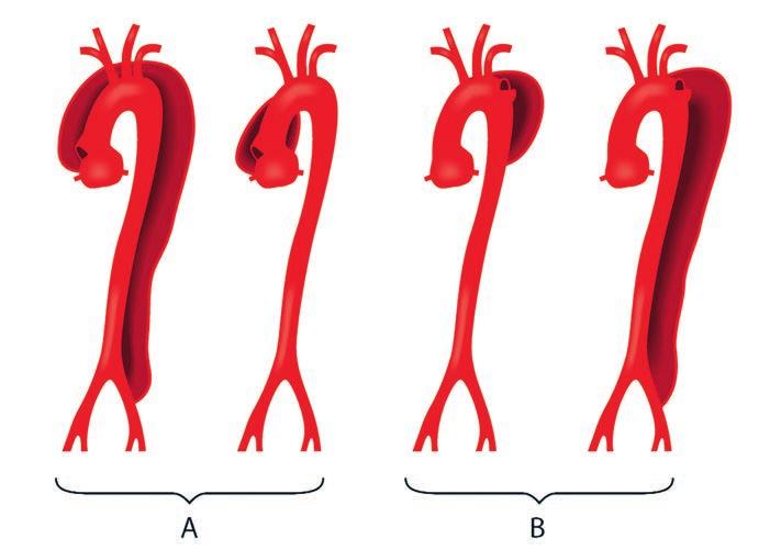 14 HJÄRT-LUNGFONDEN KLASSIFIKATION AV AORTADISSEKTION. Aortadissektion kan uppstå i olika delar av aorta och ha olika utbredning. Detta har betydelse för val av behandling och prognos.