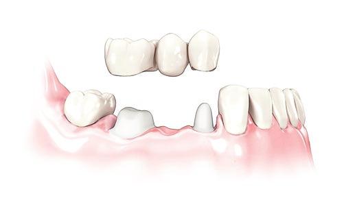 Tandersättning på tandimplantat Tandimplantat sätts in i käkbenet och fungerar precis som naturliga tandrötter.