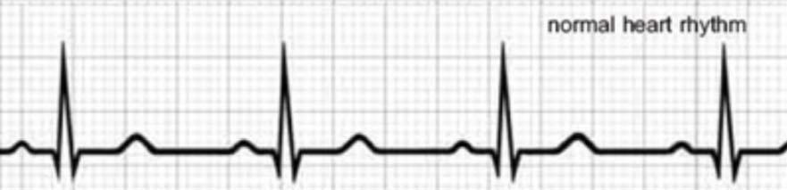 EKG