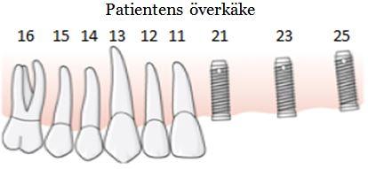 135 Tandläkaren opererar in tre implantat i överkäken och fyra implantat i underkäken.