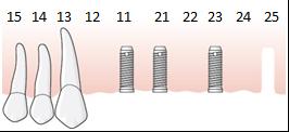 148 position 12, 22 och 24. Efter ett år sker en ny undersökning som visar att benförlusten har avstannat. En permanent konstruktion utförs i en ny ersättningsperiod. Eftersom regel E.