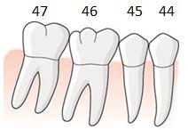 position 6 En patient har fått en infektion under mesiala roten 46 som trots