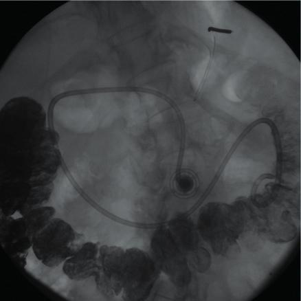 Implantationsförfarande ter placeras över guide-tråden. Fickan runt T-Porten sys igen med några stygn och ett bandage läggs om såret.