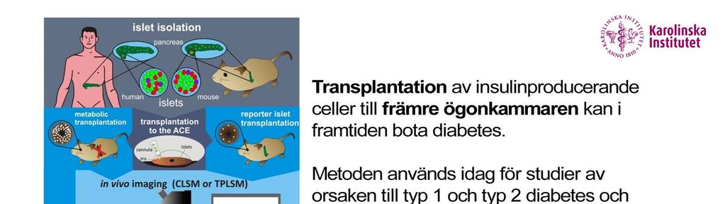 Ny teknik och nya metoder att transplantera ÖAR FRÅN PANKREAS TILL ÖGATS FRÄMRE KAMMARE UTAN ATT PÅVERKA SYNEN har utvecklats av prof.