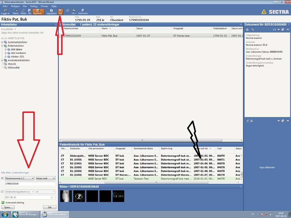 Studentmaterial radiologi Akut buk och trauma Lathund till PACS och bildgranskning Sök på personnumret i PACS i informationsfönstret (pilmarkering).