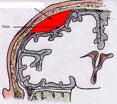 Neurologi 1. Para ihop nedanstående: (det räcker att ange rätt siffra till rätt bokstav i svaret) 1. rigiditet a. alternerande rörelser 2. positiv Babinski b. ökat muskeltonus 3. didadokokinesi c.