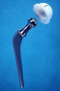 arthroplasty 1961 i Lancet Arthroplasty of the