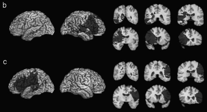 KONSTRUKTIONSAPRAXI Några resultat Performing a clock drawing task, resulted in right parietal and temporo- frontal correlates impairments in spatial number placement impairments in time setting left