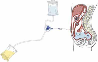 Nutrition för HD patienten Kursen syftar till att ge kunskap om såväl näringsrekommendationer som hur dessa kan anpassas till den enskilda patienten, hur man kan arbeta preventivt samt ger förslag på