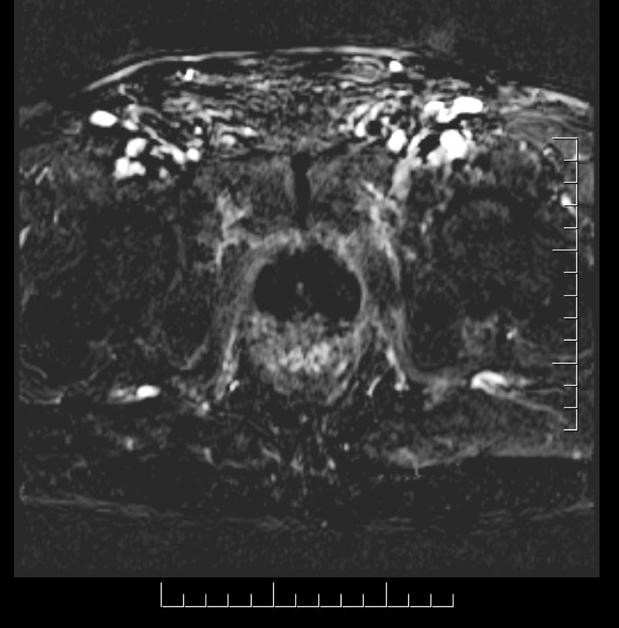 SpectraCure 2017 3 VD:s kommentar Bilder tagna vid magnetkameraundersökningar i samband med tredje patientbehandlingen i SpectraCures fas I-studie.