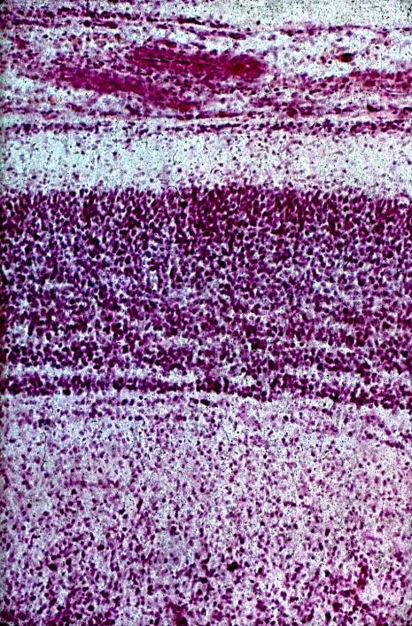 Hjärnblåsans vägg i 13e fosterveckan primära barken ännu med migrationsvågor (rippel Ri) som böljorna mot stranden, och tidigt SGL under blodkärlsrika