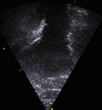 Mätning av VTI: Sample volume av pulsad Doppler placeras i mittdelen av LVOT respektive RVOT 5 10 mm apikalt om klaffen.