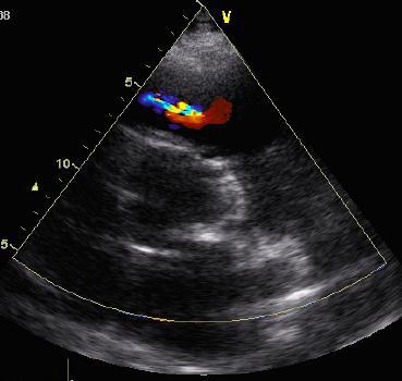4 (6) Dilaterad vänster kammare: När en uttalad vänster kammardilatation föreligger, t ex vid dilaterad kardiomyopati, får LVOT ofta ett strutformat utseende.