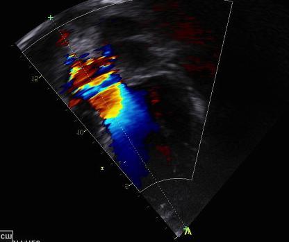 Aortastenos och aorta klaffprotes: LVOT-diameter kan vara svårbedömd hos patienter med aortastenos på grund av flera orsaker.