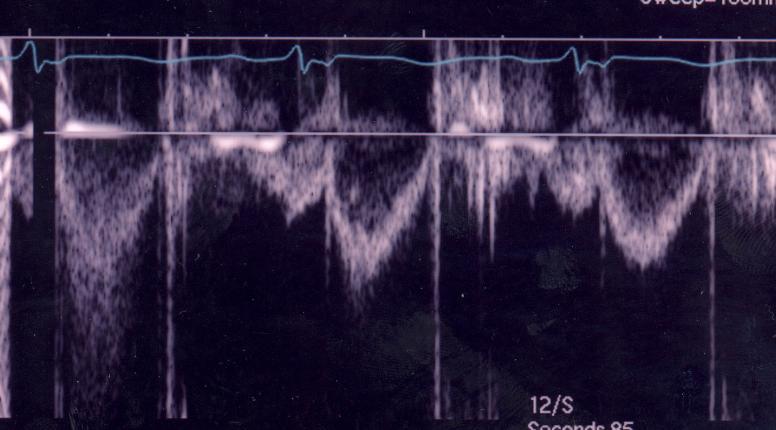Situationer då SV från LVOT inte kan användas som mått på effektiv slagvolym: När en aortainsufficiens är mer än lindrig, ger VTI med pulsad Doppler i LVOT den totala SV, som inkluderar både effektiv