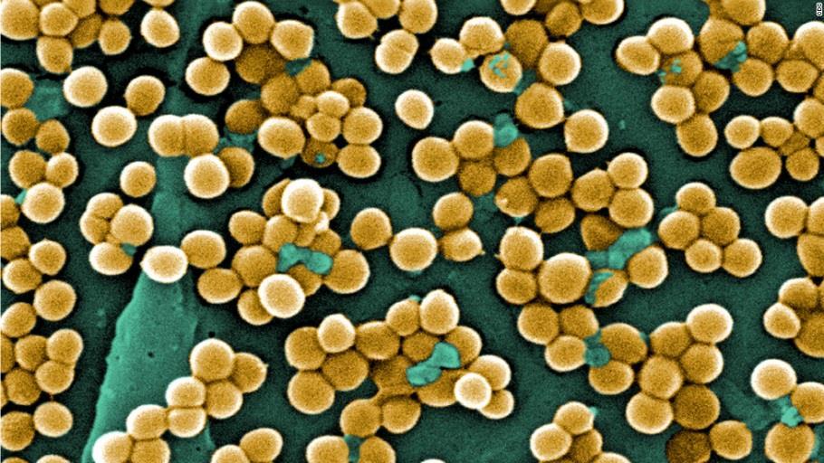 MRSA MeticillinResistenta Stafylococcus