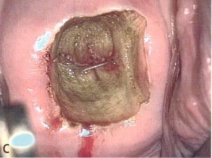 Sekundär prevention har flera steg: Screening med cytologi Bygger på att screeningprovet upprepas flera ggr under livet.