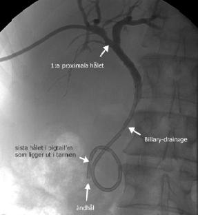 Patientfall 3 Svar: Kolecystostomi och perkutan